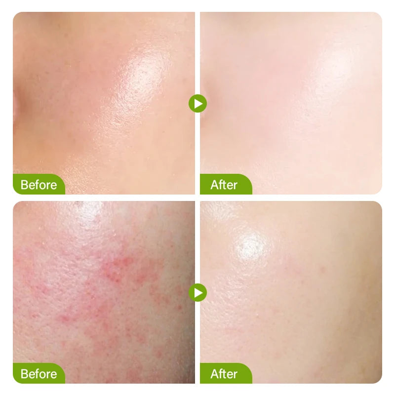 Salicylic Acid Acne Treatment Face Cream Repair Pimple Spots Deep Cleaning Pore Anti-acne Scar Oil Control Moisturizer Skin Care